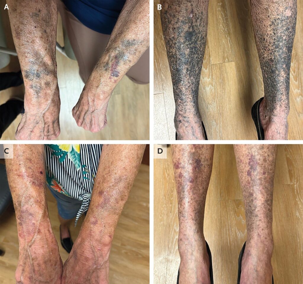 Idosa Americana Apresenta Pele Azulada e Preta Após Uso de Antibiótico: Estudo Revela Efeito Raro